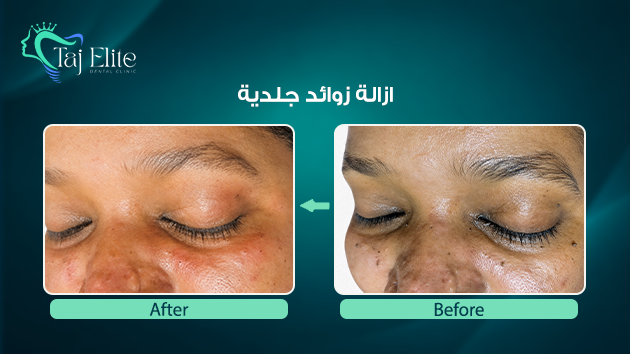 before-^-after14